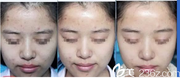 點(diǎn)陣激光祛痘前后對(duì)比案例 點(diǎn)陣激光祛痘前后對(duì)比案例