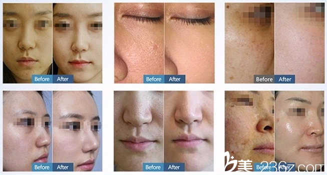 王愛(ài)梅院長(zhǎng)激光祛斑前后對(duì)比案例 王愛(ài)梅院長(zhǎng)激光祛斑前后對(duì)比案例