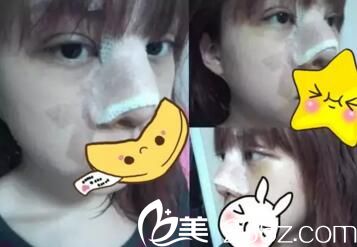 鄭州藝齡張志成做眼鼻整形術(shù)后3天 鄭州藝齡張志成做眼鼻整形術(shù)后3天