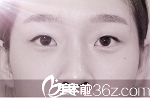 術(shù)前單眼皮的我 術(shù)前單眼皮的我
