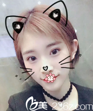 重慶華美雙眼皮術(shù)后13天 重慶華美雙眼皮術(shù)后13天