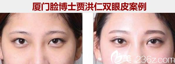 廈門臉博士整形醫(yī)院賈洪仁雙眼皮案例圖 廈門臉博士整形醫(yī)院賈洪仁雙眼皮案例圖