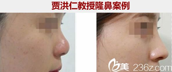 廈門臉博士賈洪仁鼻綜合隆鼻一年后恢復效果 廈門臉博士賈洪仁鼻綜合隆鼻一年后恢復效果