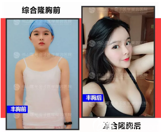 找佛山曙光金子何宜新綜合假體豐胸前后對(duì)比圖
