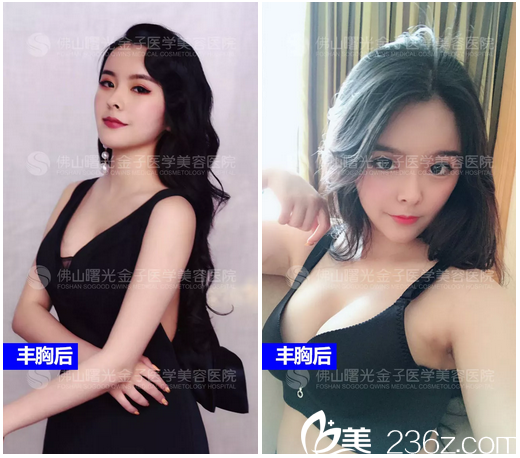 佛山曙光金子何宜新隆胸案例術(shù)后寫(xiě)真圖片