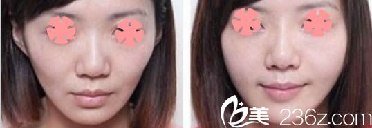 廈門臉博士折濤自體脂肪面部填充案例 廈門臉博士折濤自體脂肪面部填充案例