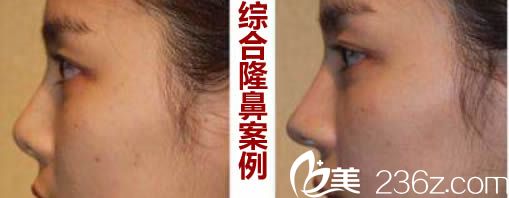 折濤醫(yī)生鼻綜合整形前后對比效果 折濤醫(yī)生鼻綜合整形前后對比效果