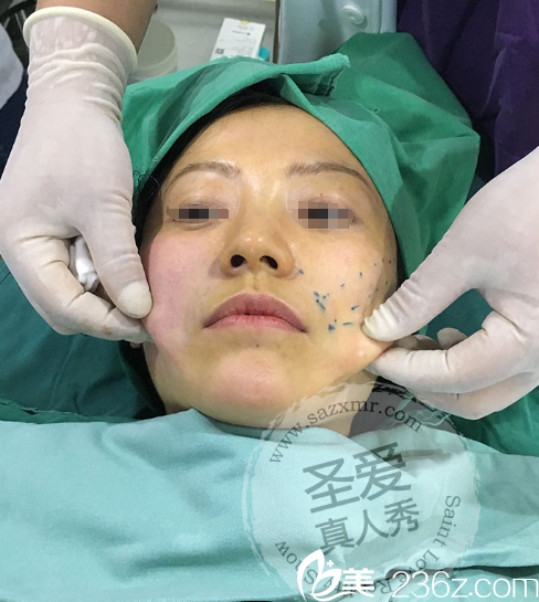 勝院長面部提升手術(shù)過程中