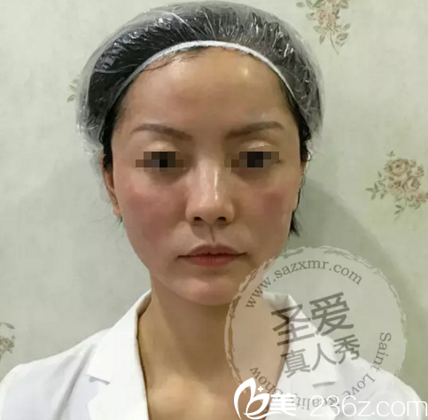 埋線提升術(shù)后即刻效果