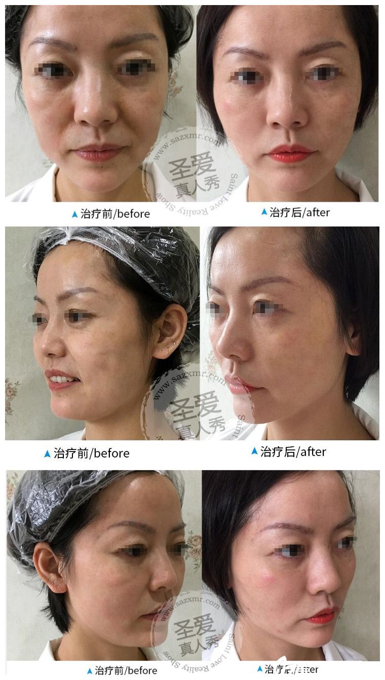 在<!--<i data=20240703-sp></i>-->做面部埋線提升術(shù)后一周恢復(fù)