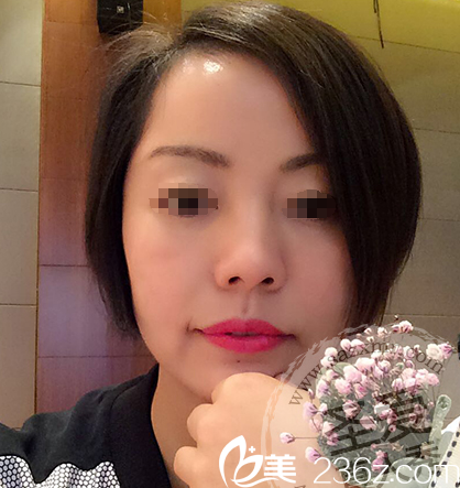 咨詢師親身體驗4D精雕塑形 院長用埋線提拉為她告別下垂衰老的面部