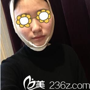 輪廓整形術(shù)后3天效果