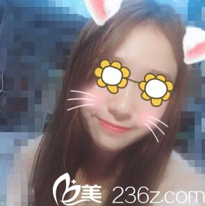 在美貪做下頜角術(shù)后1個月效果