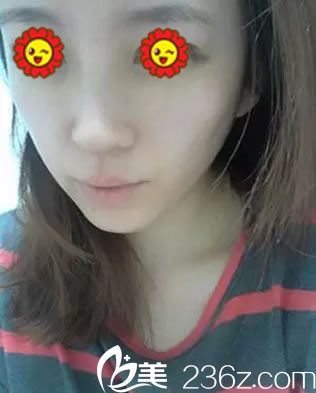 在臺州維多利亞做隆鼻術(shù)后30天