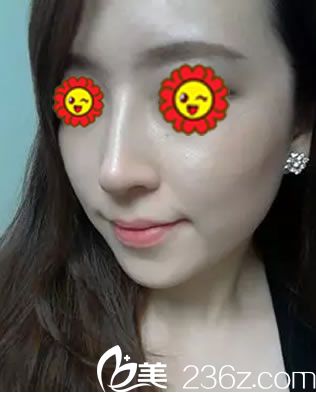 臺州維多利亞常文彥隆鼻<span style=