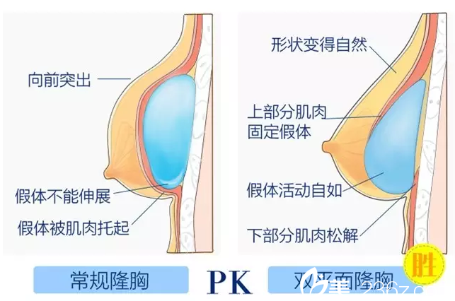 在南寧夢想做假體隆胸手術(shù)優(yōu)勢