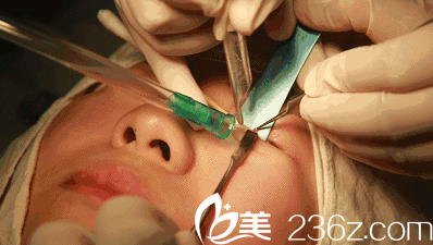 金嵐ABL激光無痕祛眼袋手術過程