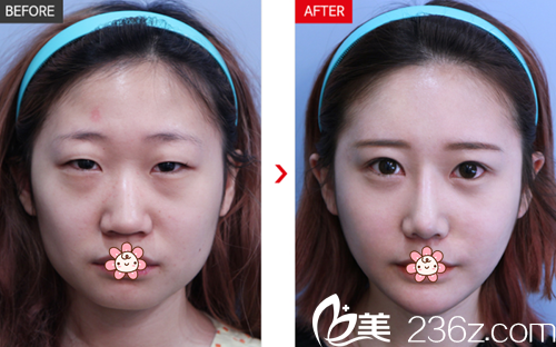 樸德俊院長雙眼皮隆鼻案例 樸德俊院長雙眼皮隆鼻案例