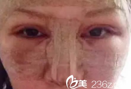 做完雙眼皮和假體隆鼻第2天的樣子