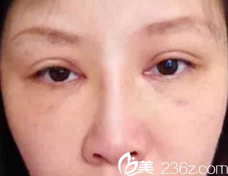 本人6月10日去廈門臉博士整形醫(yī)院讓曾輝武做了雙眼皮和隆鼻，大家評價下效果如何？