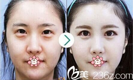 樸炳浩院長(zhǎng)眼底脂肪祛除案例 樸炳浩院長(zhǎng)眼底脂肪祛除案例