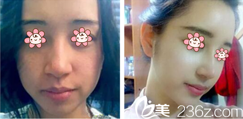 徐東麟院長(zhǎng)隆鼻案例 徐東麟院長(zhǎng)隆鼻案例