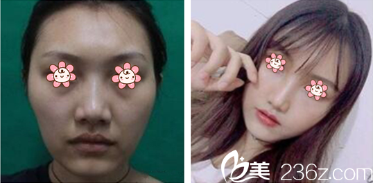 洪龍澤院長面部脂肪填充案例 洪龍澤院長面部脂肪填充案例