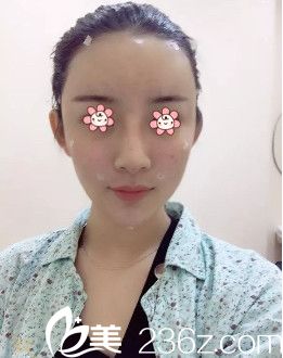 胡煜醫(yī)生給我填充完當(dāng)天