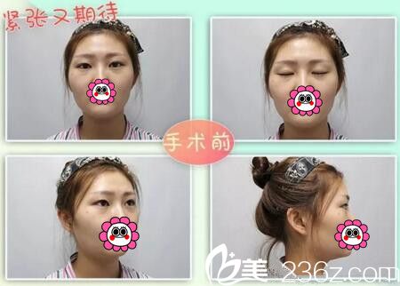 雙眼皮面部填充術(shù)前照 雙眼皮面部填充術(shù)前照