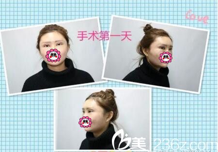 整形手術(shù)術(shù)后天 整形手術(shù)術(shù)后天