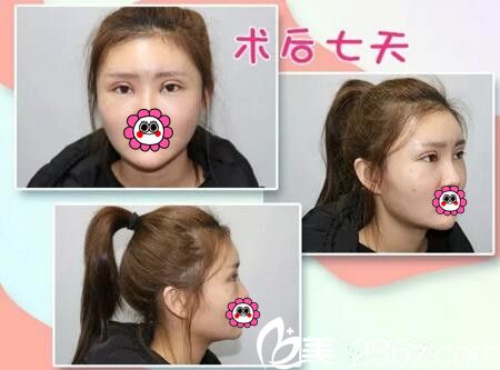 雙眼皮填充術(shù)后一周 雙眼皮填充術(shù)后一周