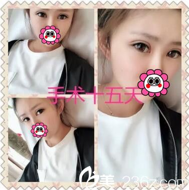 面部脂肪填充雙眼皮術(shù)后半個月<span style= 面部脂肪填充雙眼皮術(shù)后半個月<span style=