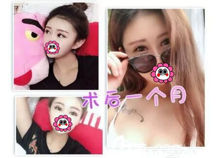 面部脂肪填充+雙眼皮術(shù)后一個月<span style= 面部脂肪填充+雙眼皮術(shù)后一個月<span style=