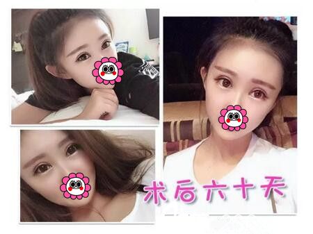 分享我在海南韓美做自體脂肪填充面部+眼綜合術(shù)后兩個月恢復(fù)效果圖