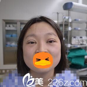 眼綜合術(shù)后即刻照