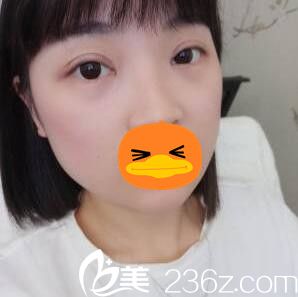 看我在整形醫(yī)院做全切雙眼皮+開(kāi)眼角術(shù)后1個(gè)月恢復(fù)效果，我挺喜歡的！