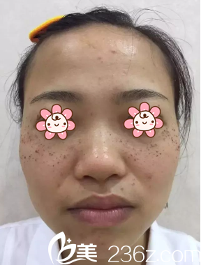 張<!--<i data=20240703-sp></i>-->給我祛斑當天