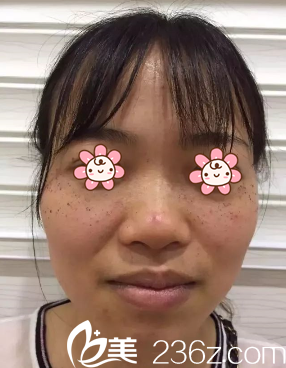 貴州利美康激光祛斑術后五天