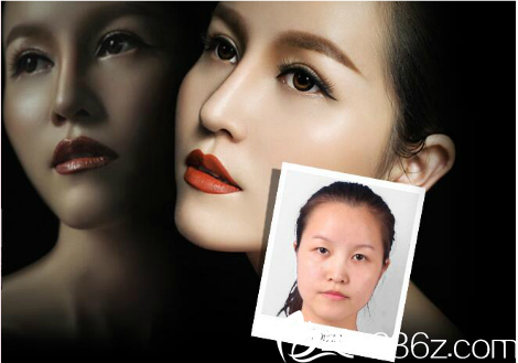 整形醫(yī)院羅志敏隆鼻案例