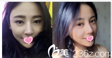 北京圣嘉榮黃大勇隆鼻<span style=