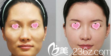 北京圣嘉榮黃大勇面部脂肪填充<span style=