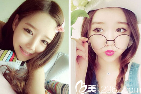 感覺做了輪廓這個手術(shù)后自己年輕了好幾歲呢