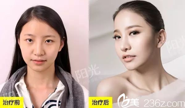 <!--<i data=20240703-sp></i>-->整形醫(yī)院雙眼皮隆鼻案例效果圖