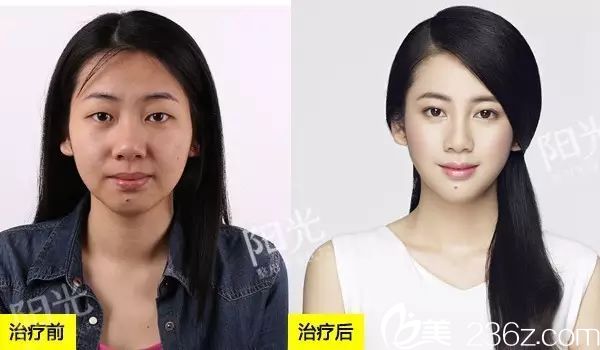 <!--<i data=20240703-sp></i>-->整形醫(yī)院雙眼皮整形案例圖