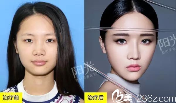 <!--<i data=20240703-sp></i>-->整形醫(yī)院隆鼻和自體脂肪全臉填充案例圖