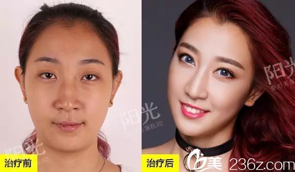 <!--<i data=20240703-sp></i>-->整形醫(yī)院雙眼皮隆鼻案例對比圖