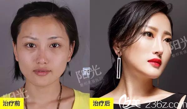 <!--<i data=20240703-sp></i>-->整形醫(yī)院雙眼皮和脂肪填充效果圖