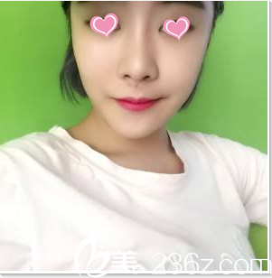 聊聊我在醫(yī)院找金秋燕做面部脂肪填充經(jīng)歷朋友說效果自然美觀