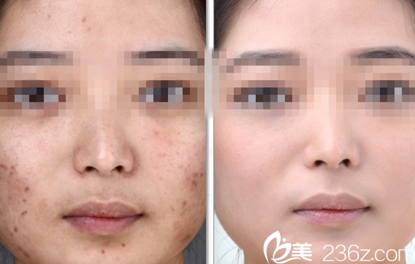 祛痘對比圖