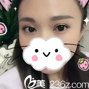 雙眼皮手術(shù)后20天